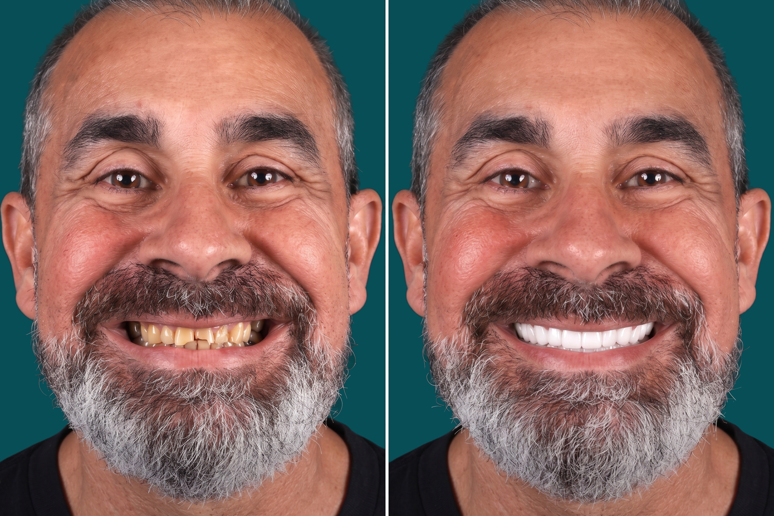 Dental-Crowns 1