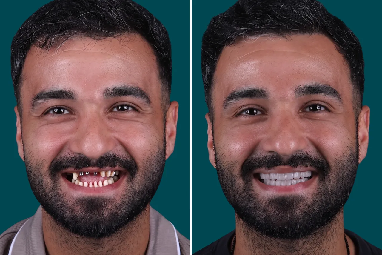 Dental-Implants 1