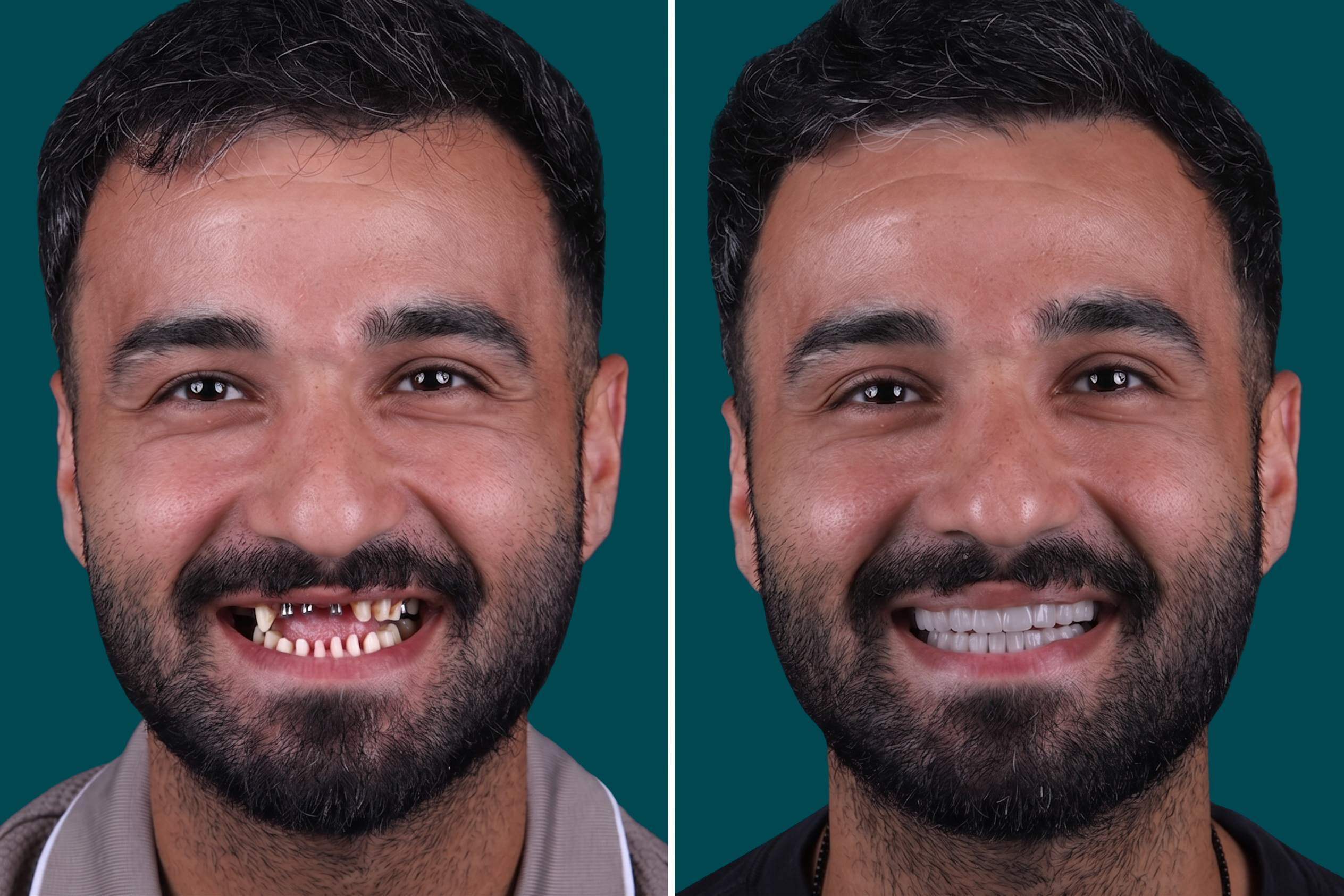 Dental-Implants 1