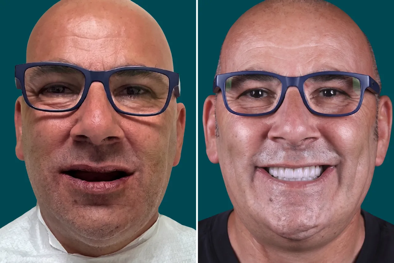 Dental-Implants 2