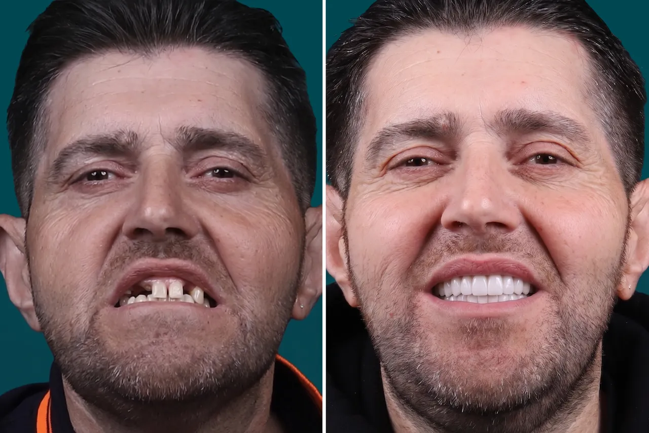Dental-Implants 3