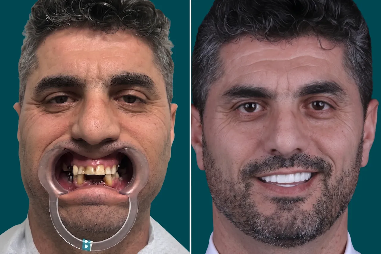 Dental-Implants 4