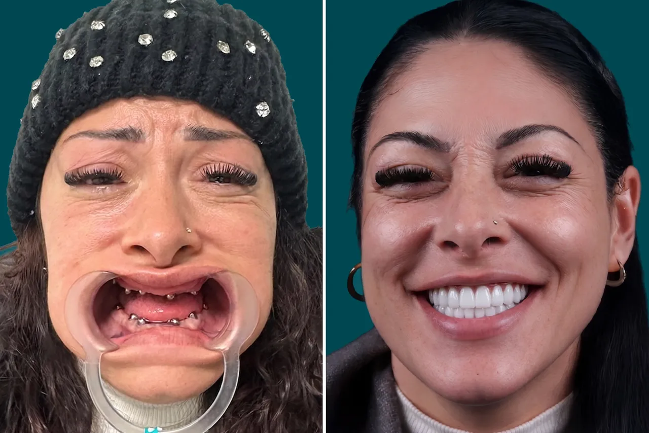 Dental Implants 5