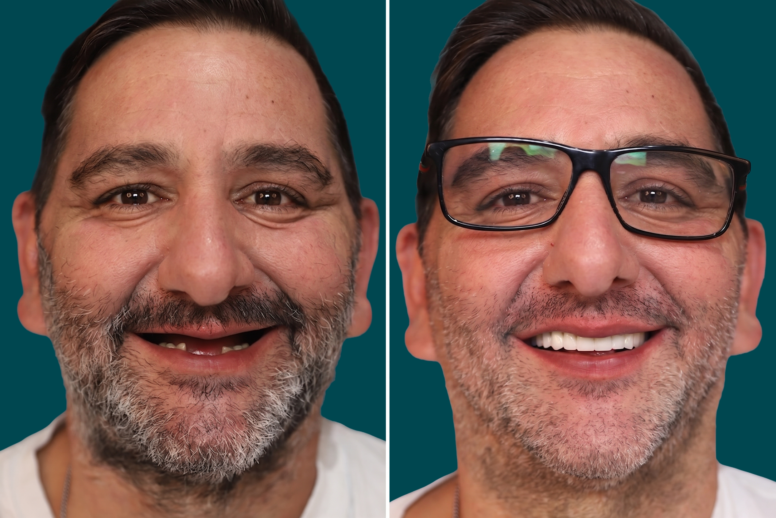 Dental Implants 6