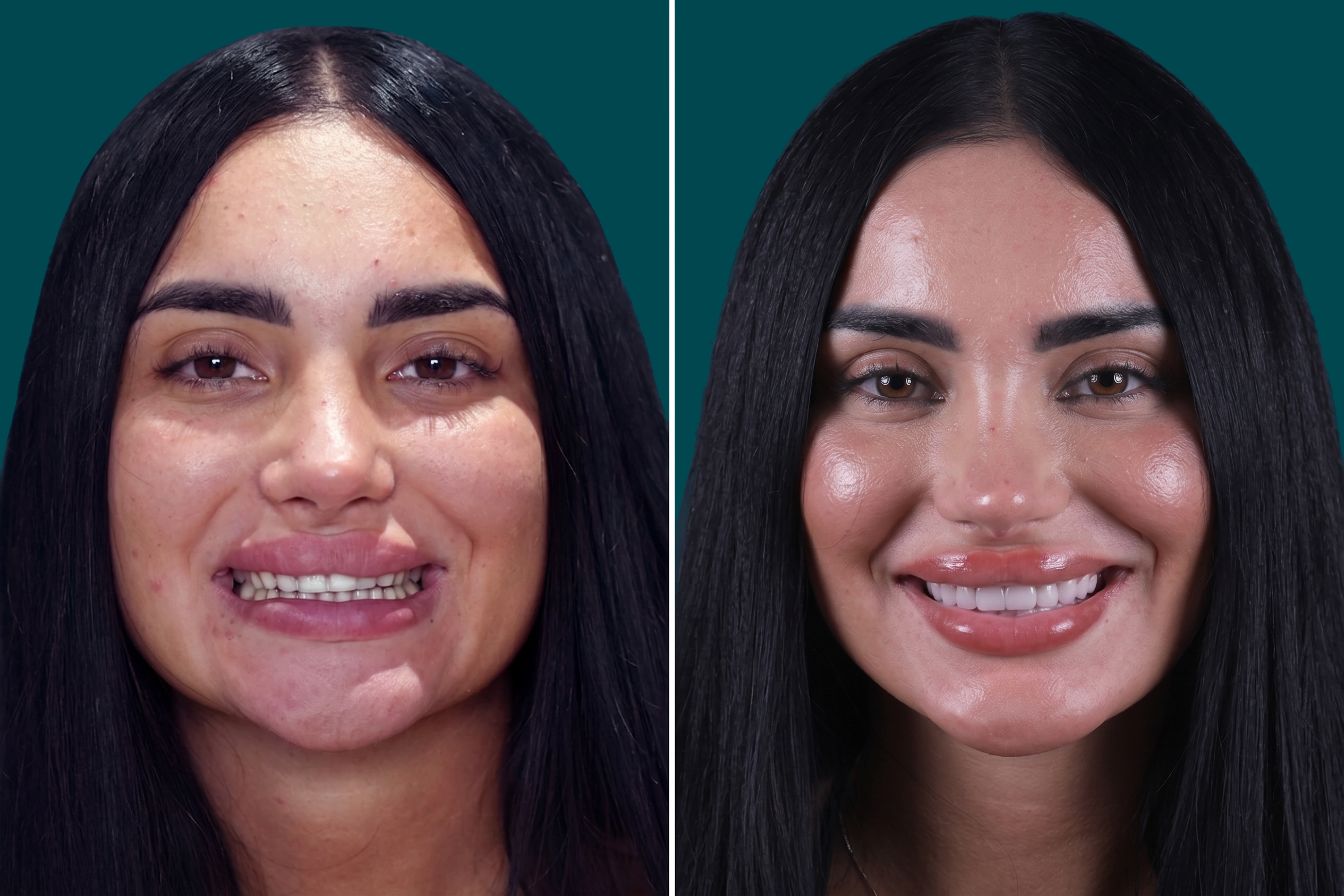 Dental-Veneers 1