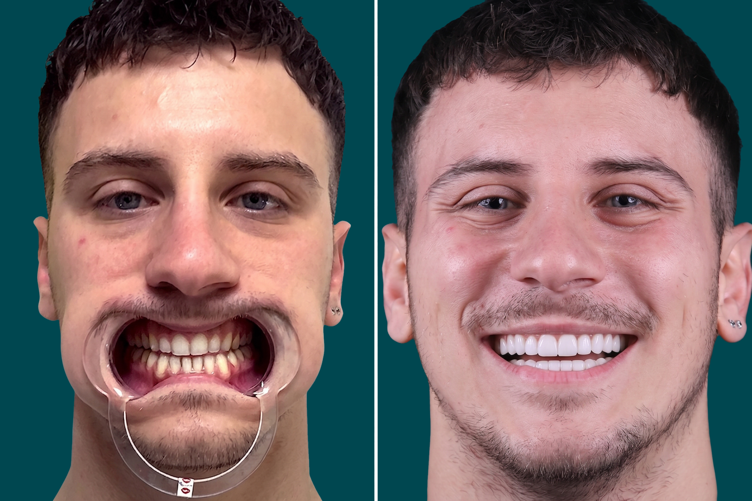 Dental-Veneers 2