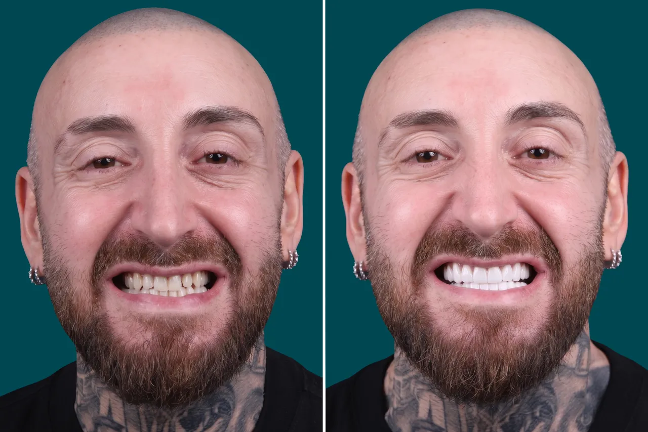 Dental-Veneers 3