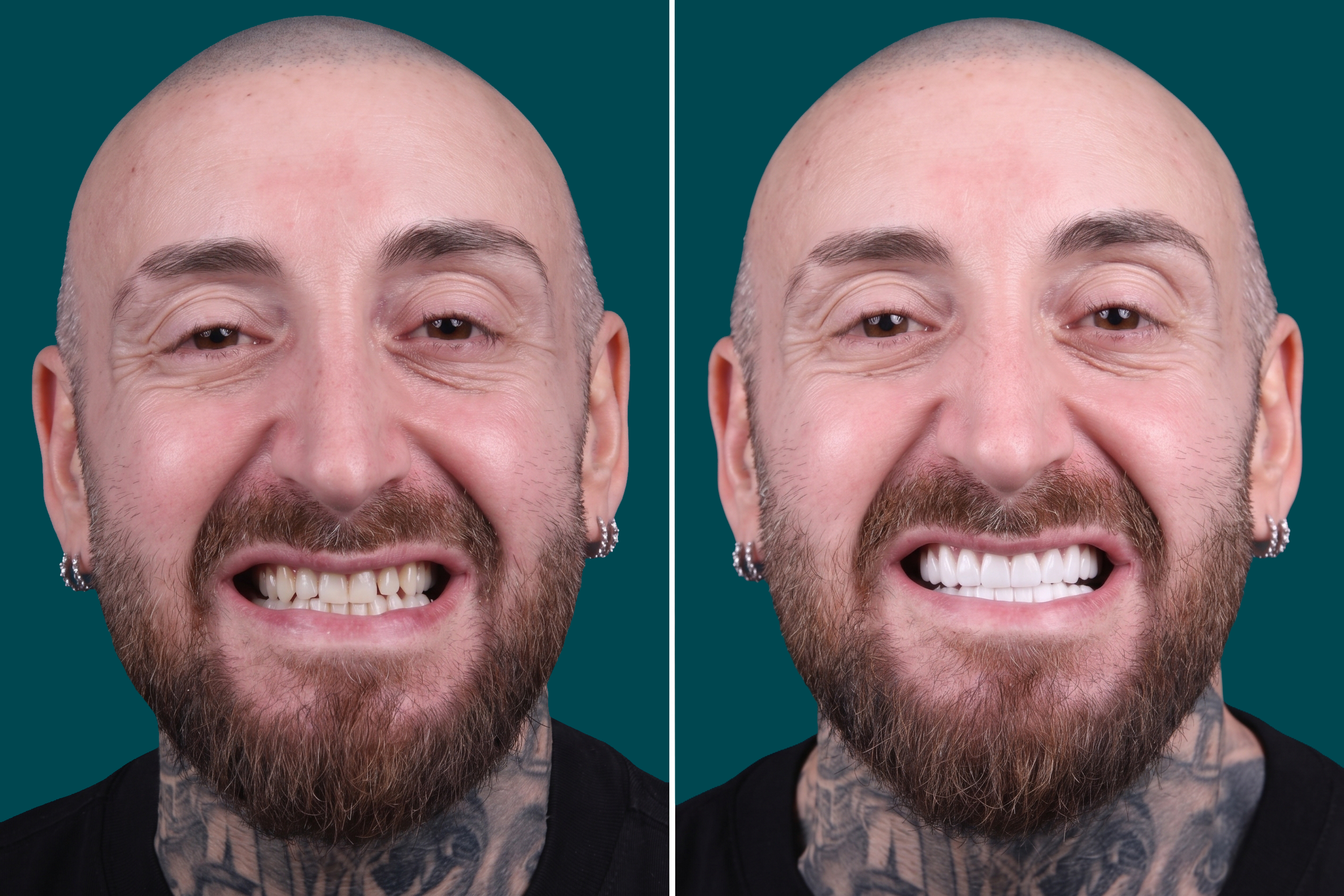 Dental-Veneers 3