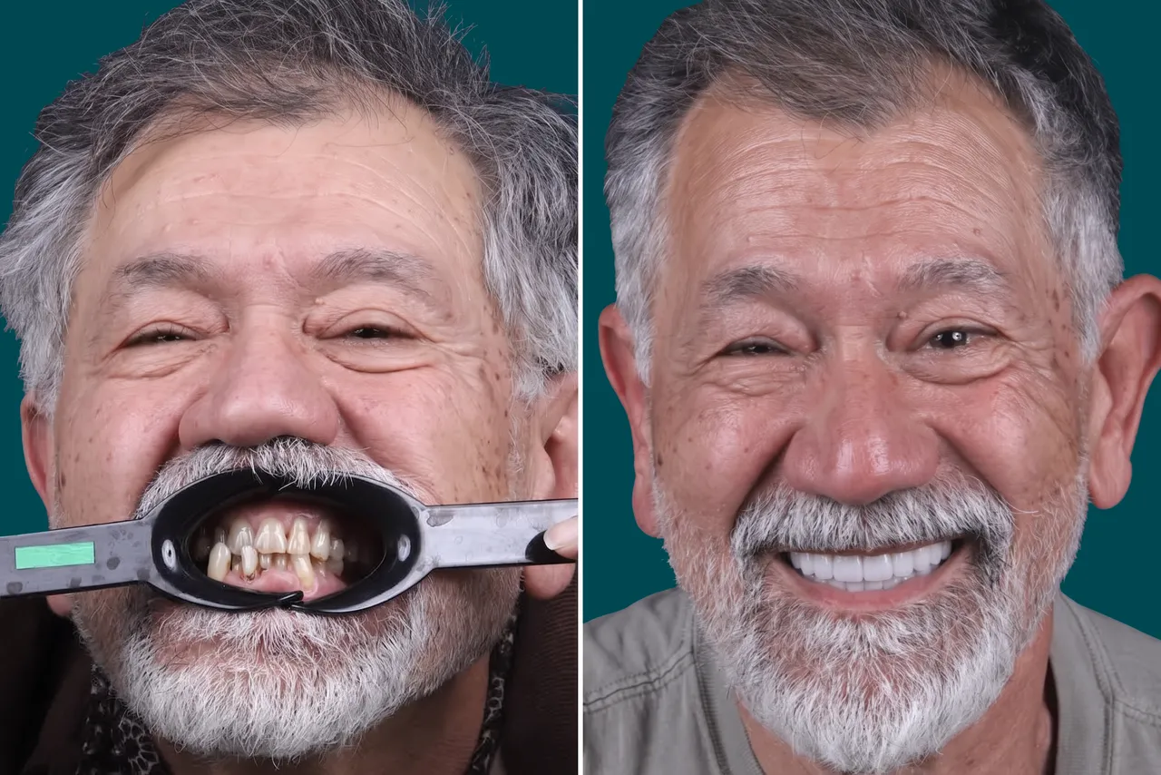 Smile-Makeover-Digital Smile Design 4