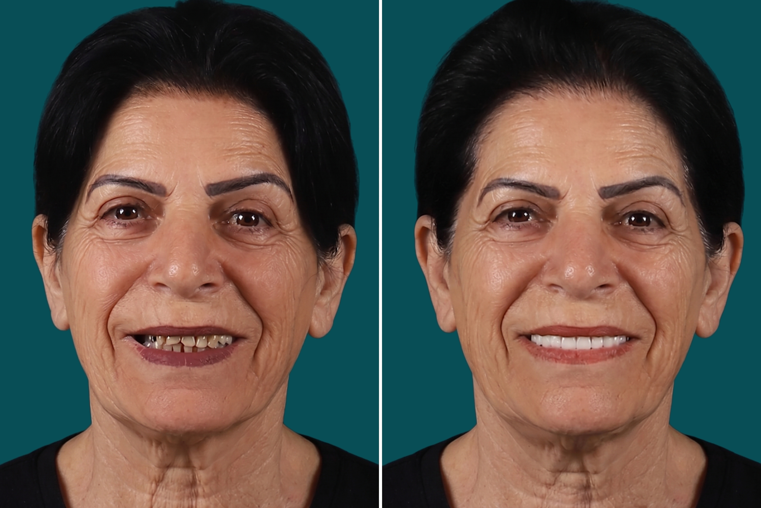 Smile-Makeover-Digital Smile Design 2