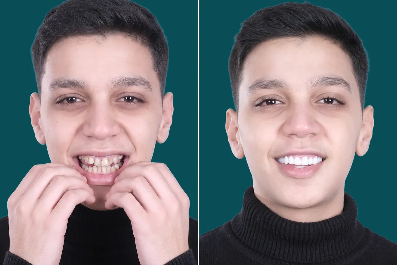Smile-Makeover-Digital Smile Design 3