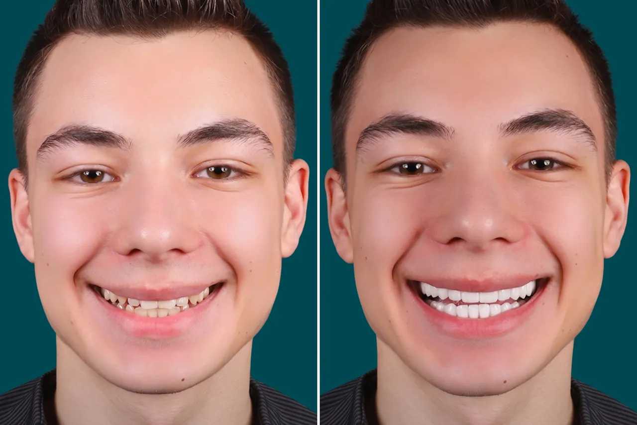 Dental-Crowns- E max Crowns 2