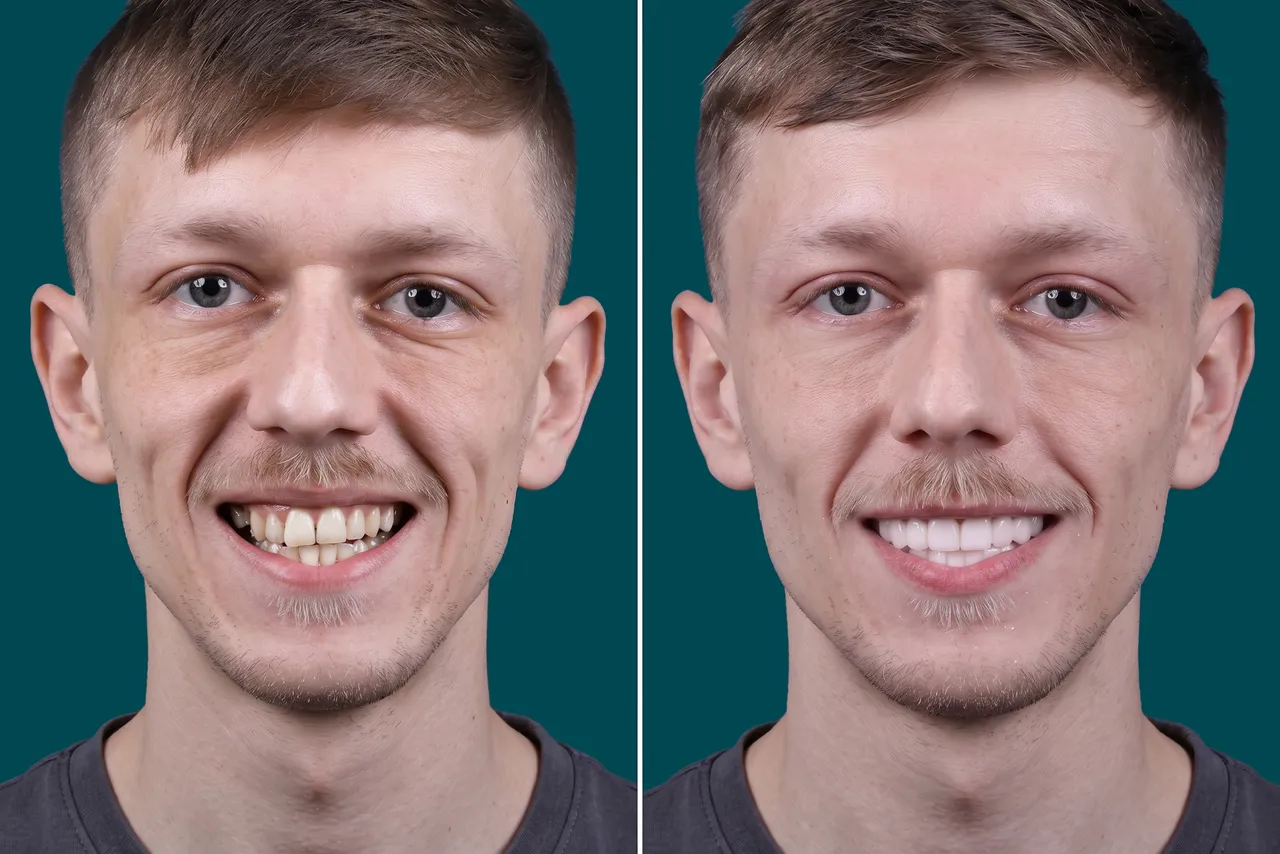 Dental-Veneers- E max veneers 1