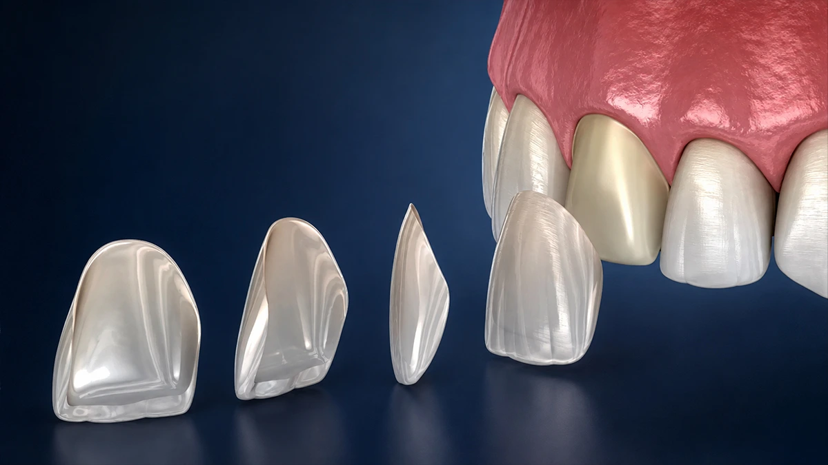Emax-Veneers