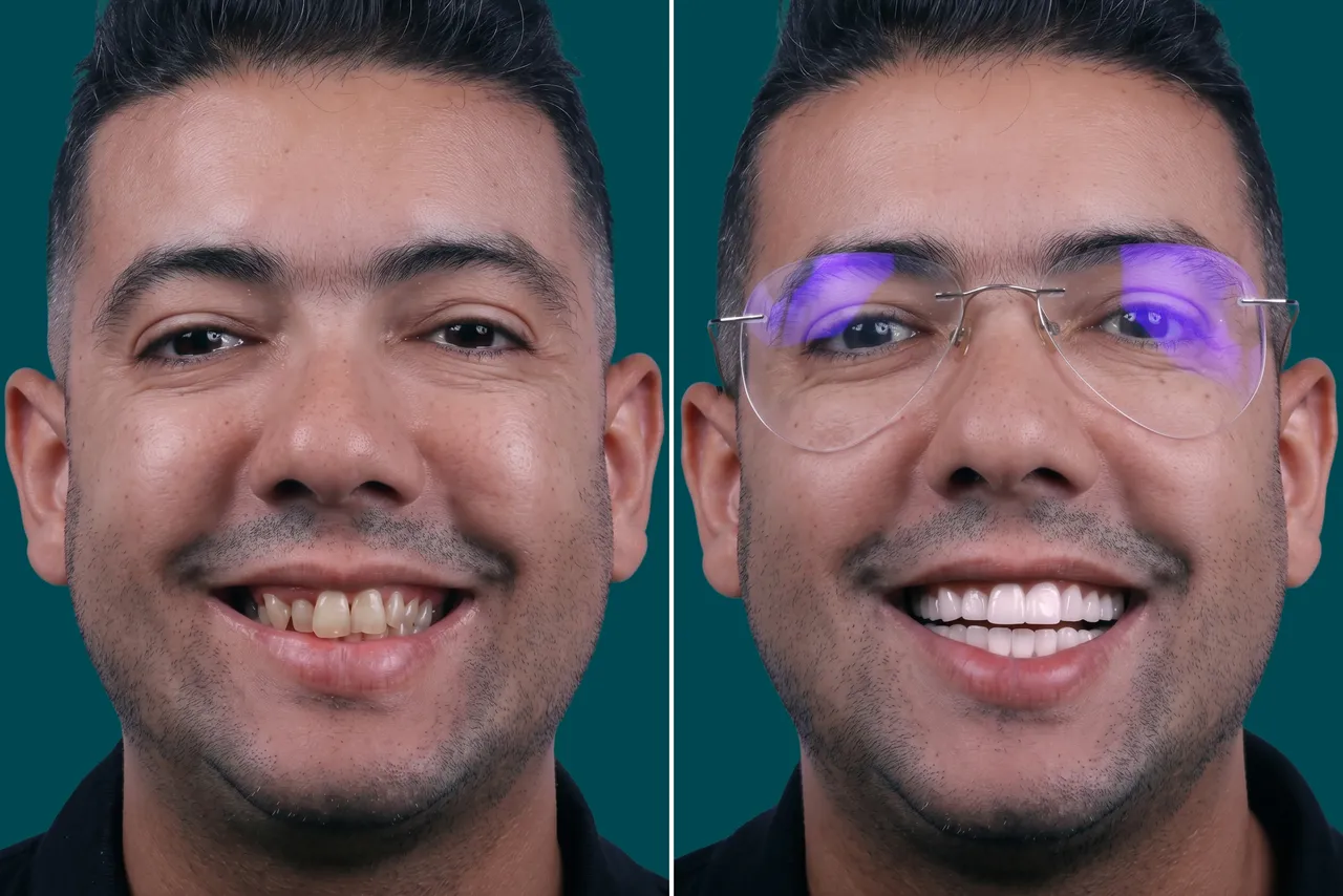 Dental-Veneers- E max veneers 2