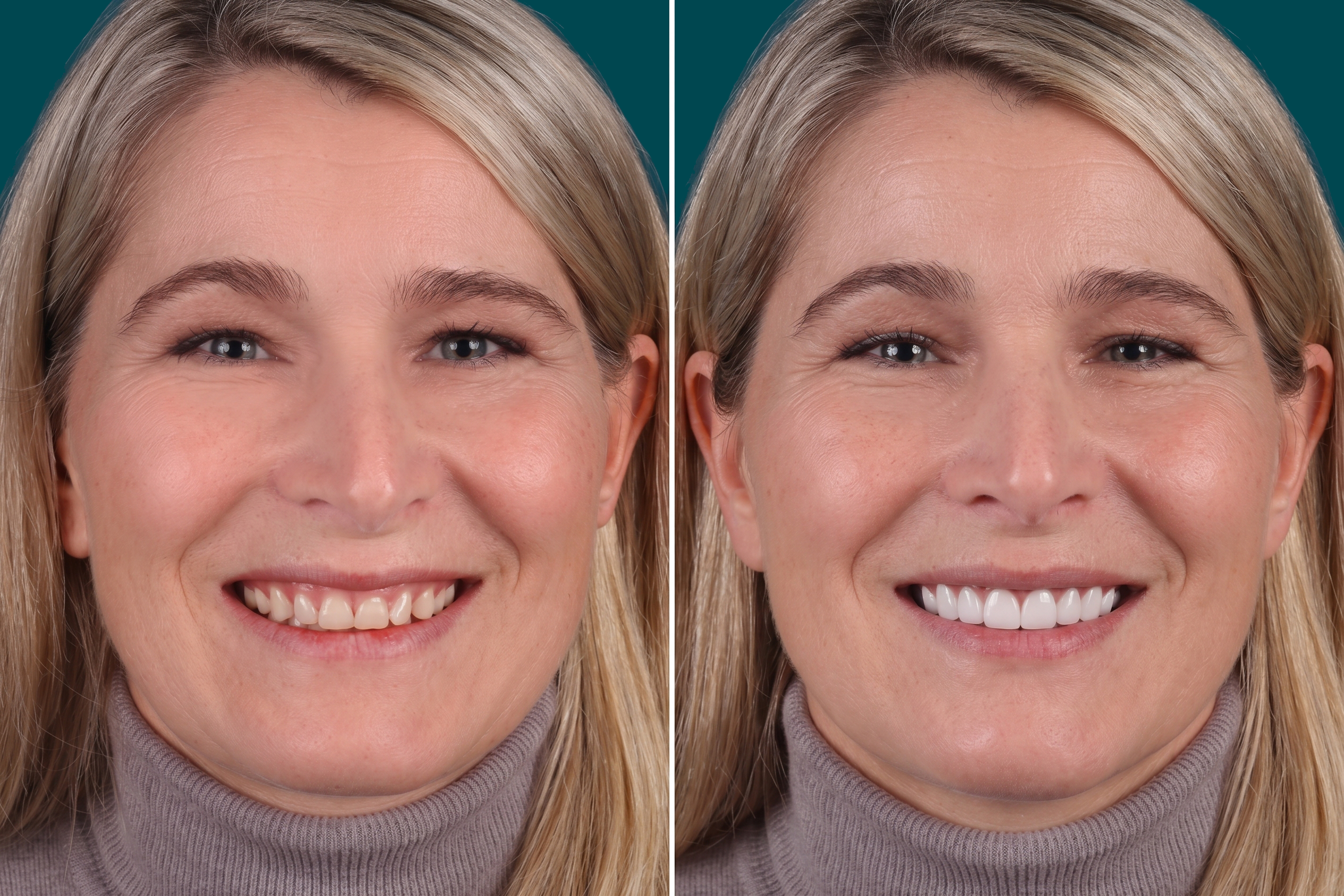 Dental-Veneers- E max veneers 3