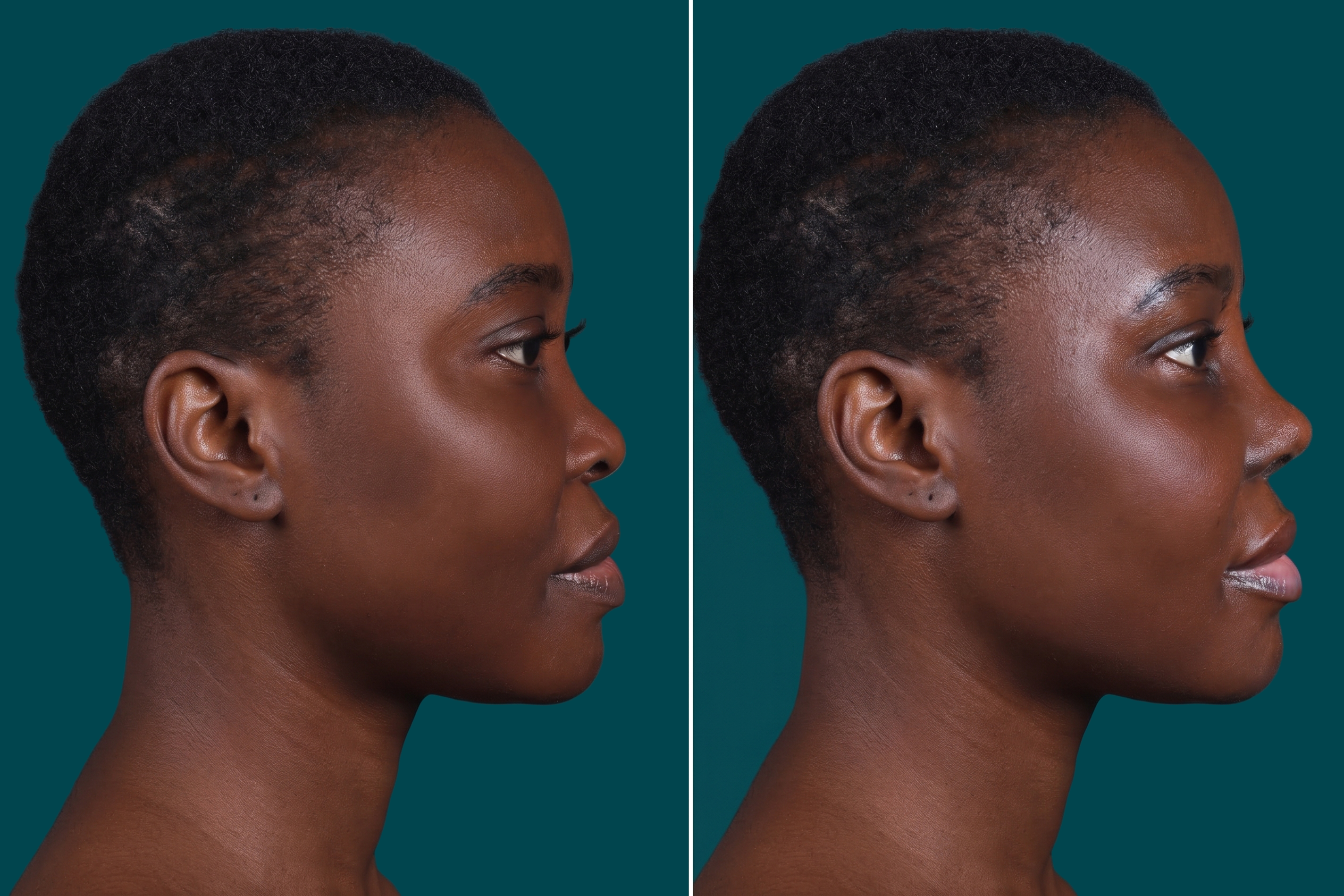Ethnic Rhinoplasty Before and After 1
