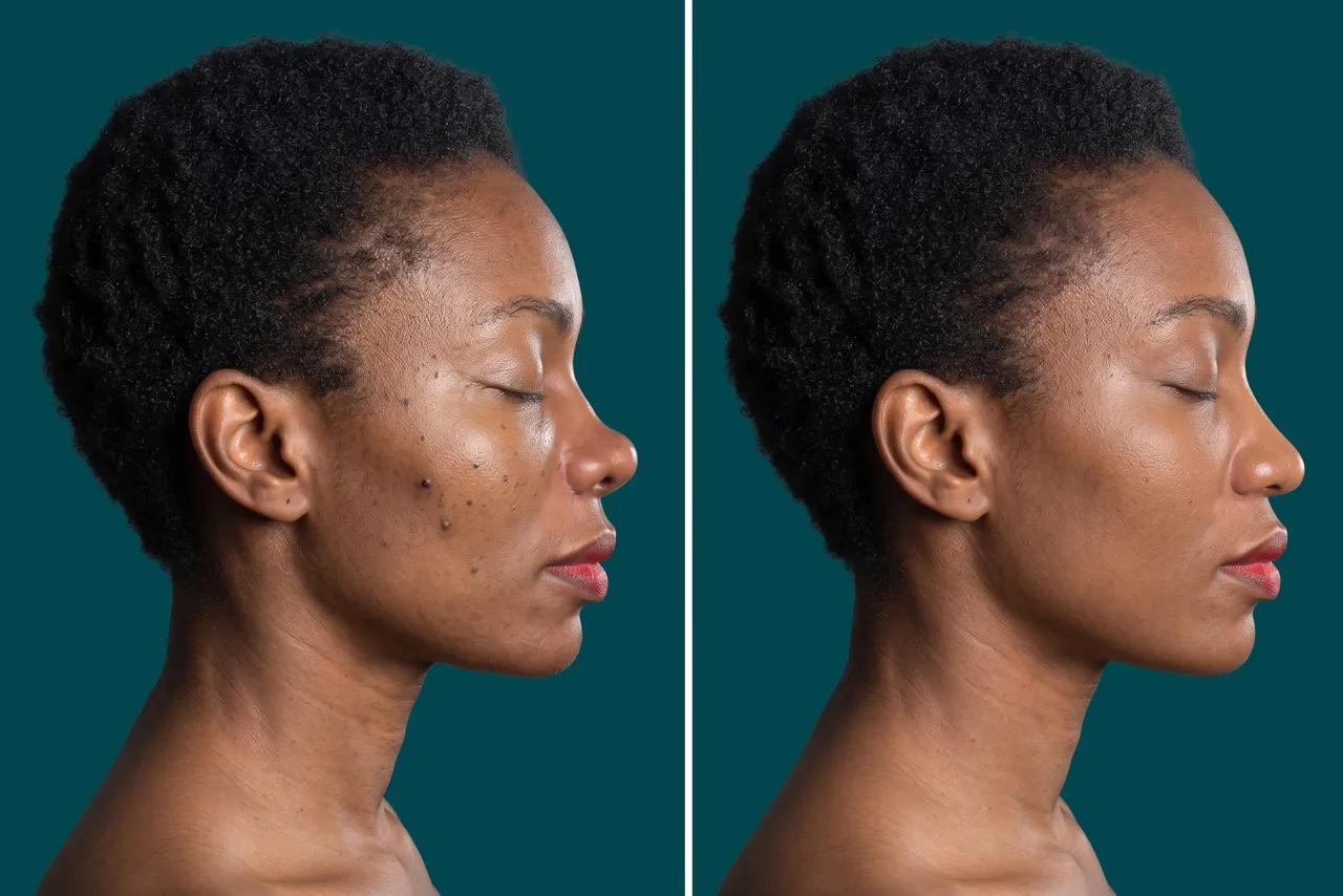 Ethnic Rhinoplasty Before and After 2