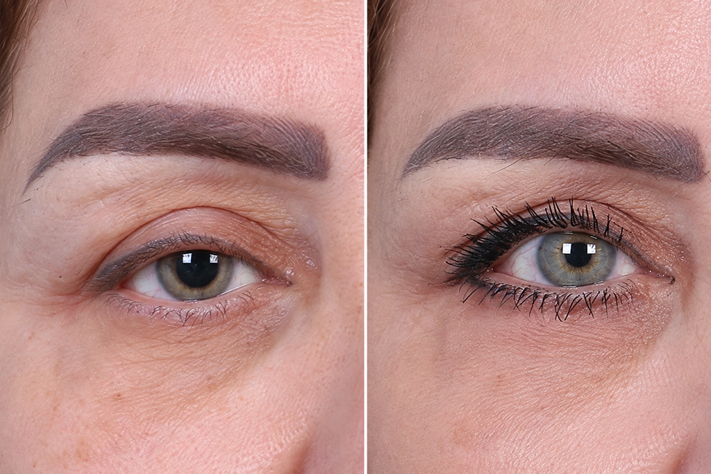 Eyelid Surgery Before After In Turkey 5