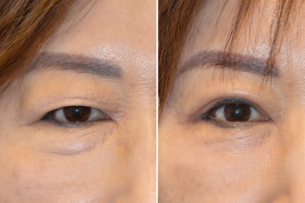 Eyelid Surgery Before After In Turkey 9