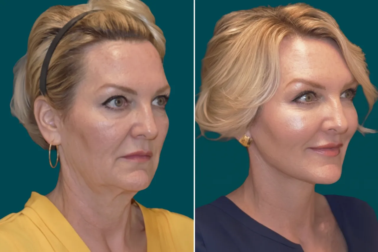 Facelift Before and After 1