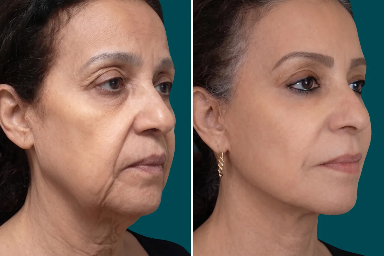 Facelift Before and After 10