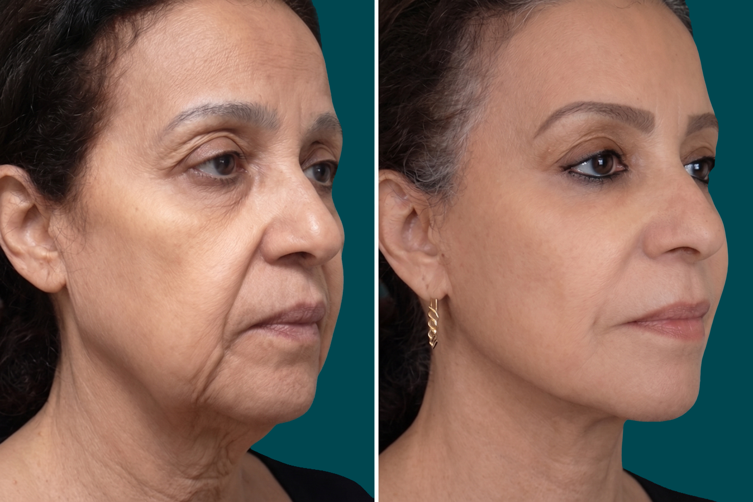 Facelift Before and After 10