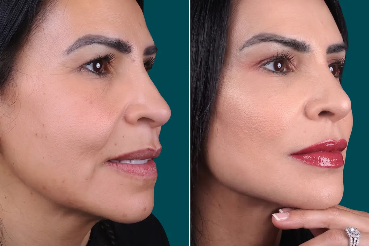 Facelift Before and After 2