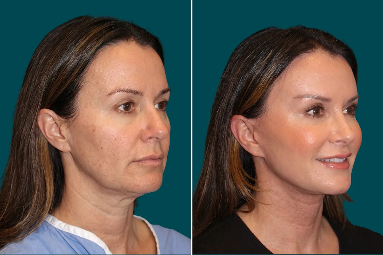 Facelift Before and After 3