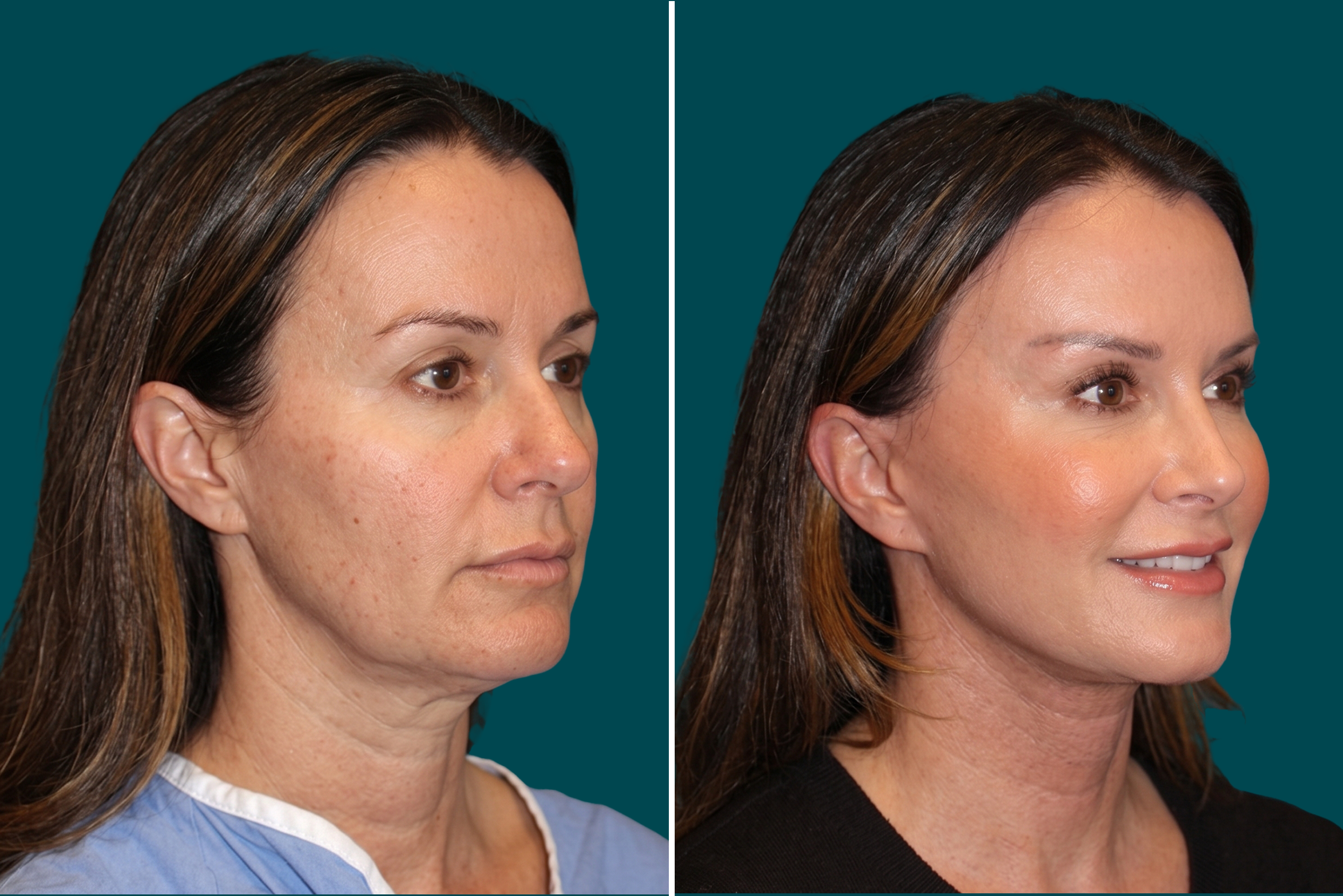 Facelift Before and After 3