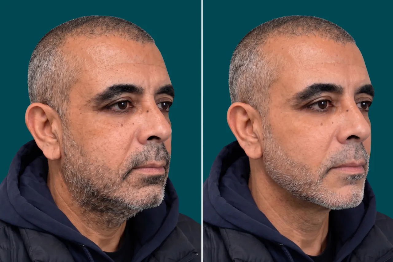 Facelift Before and After 4