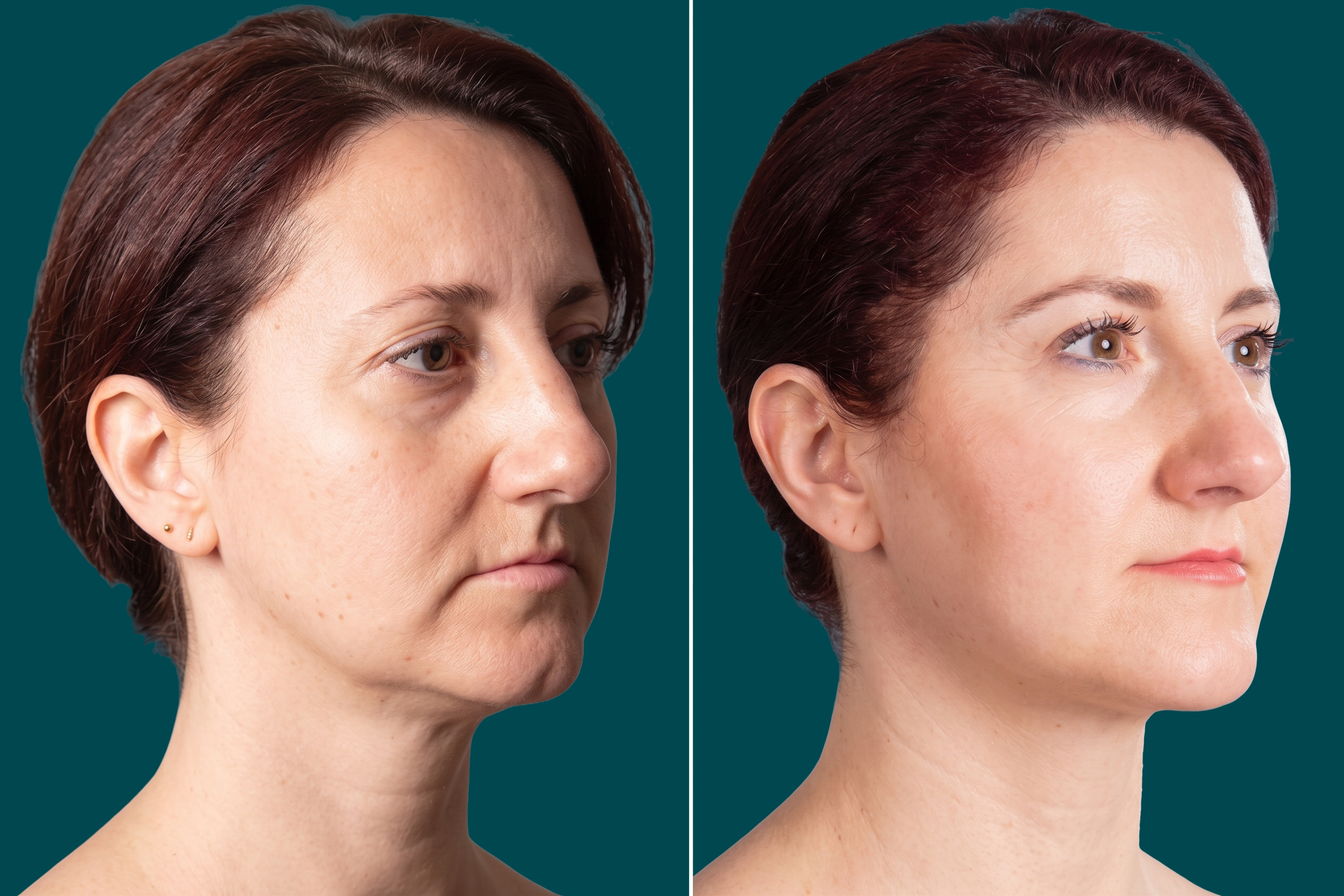Facelift Before and After 5