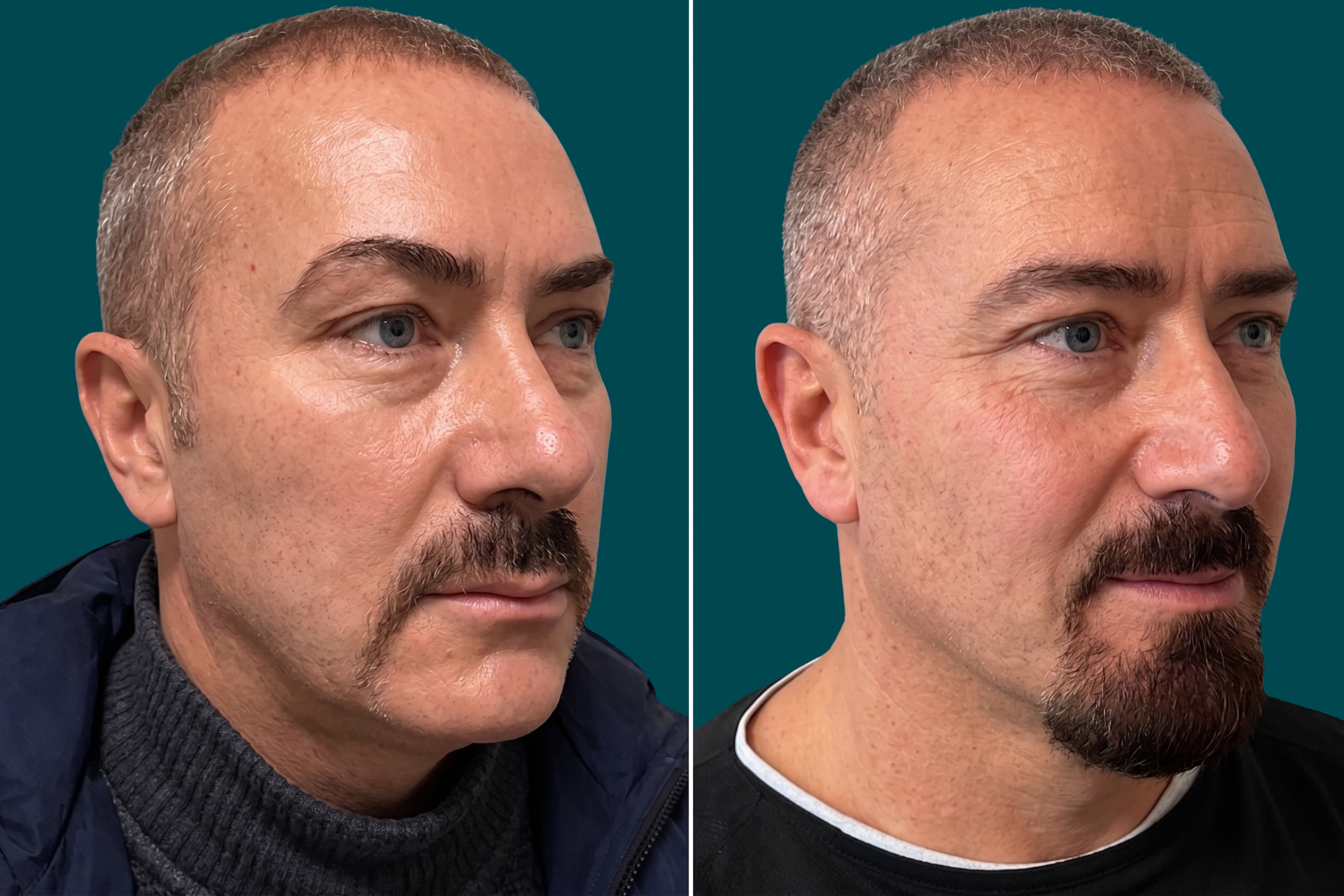 Facelift Before and After 6