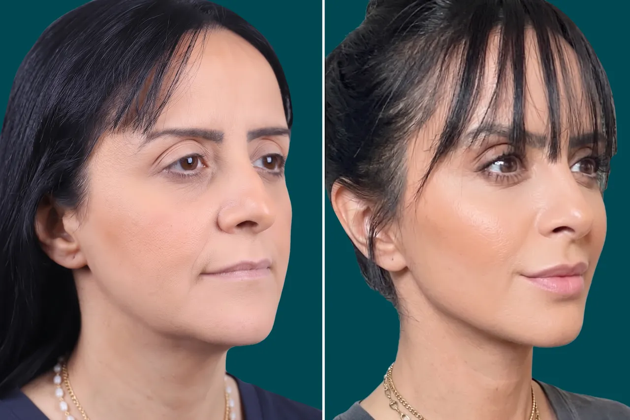Facelift Before and After 7