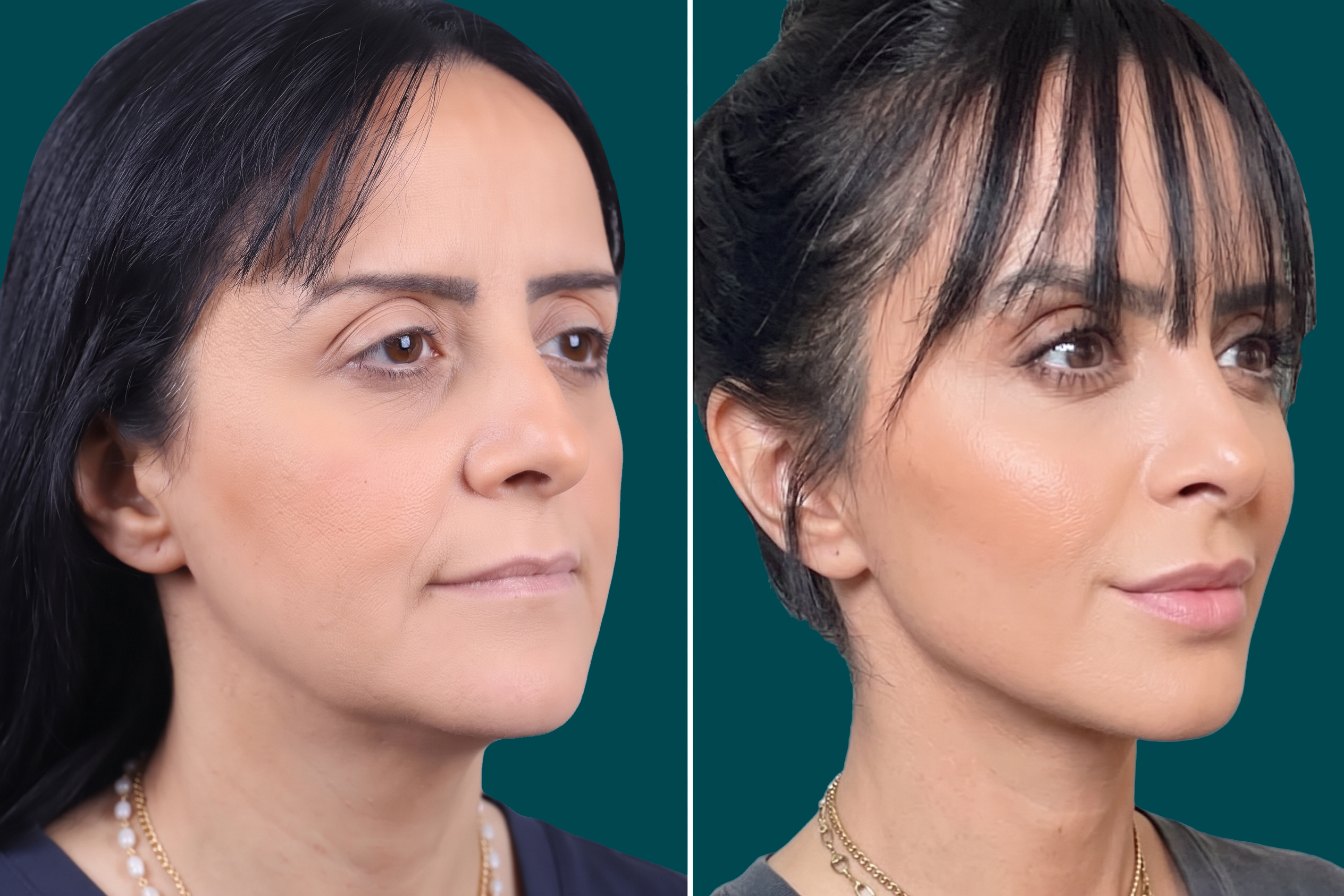 Facelift Before and After 7