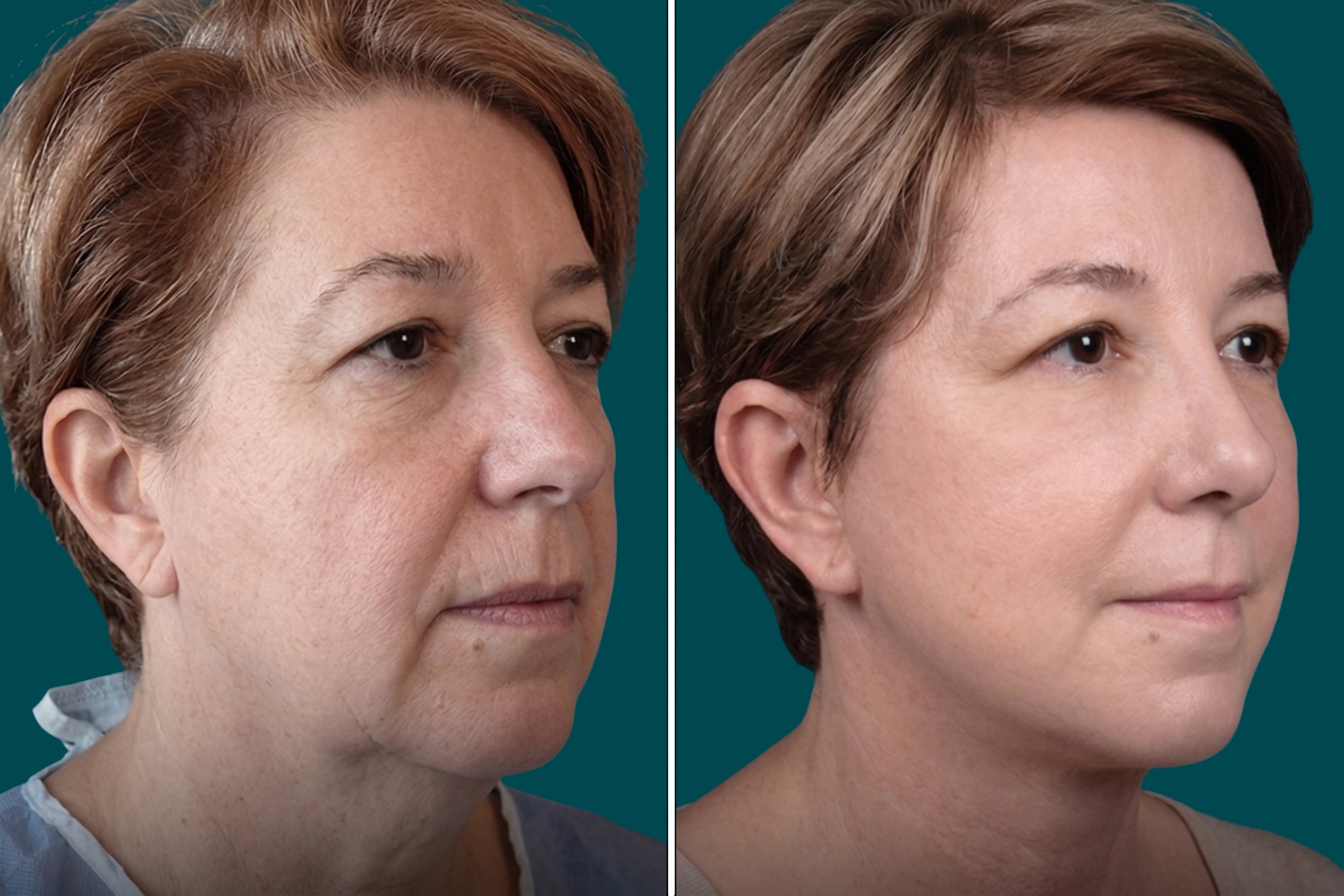 Facelift Before and After 9