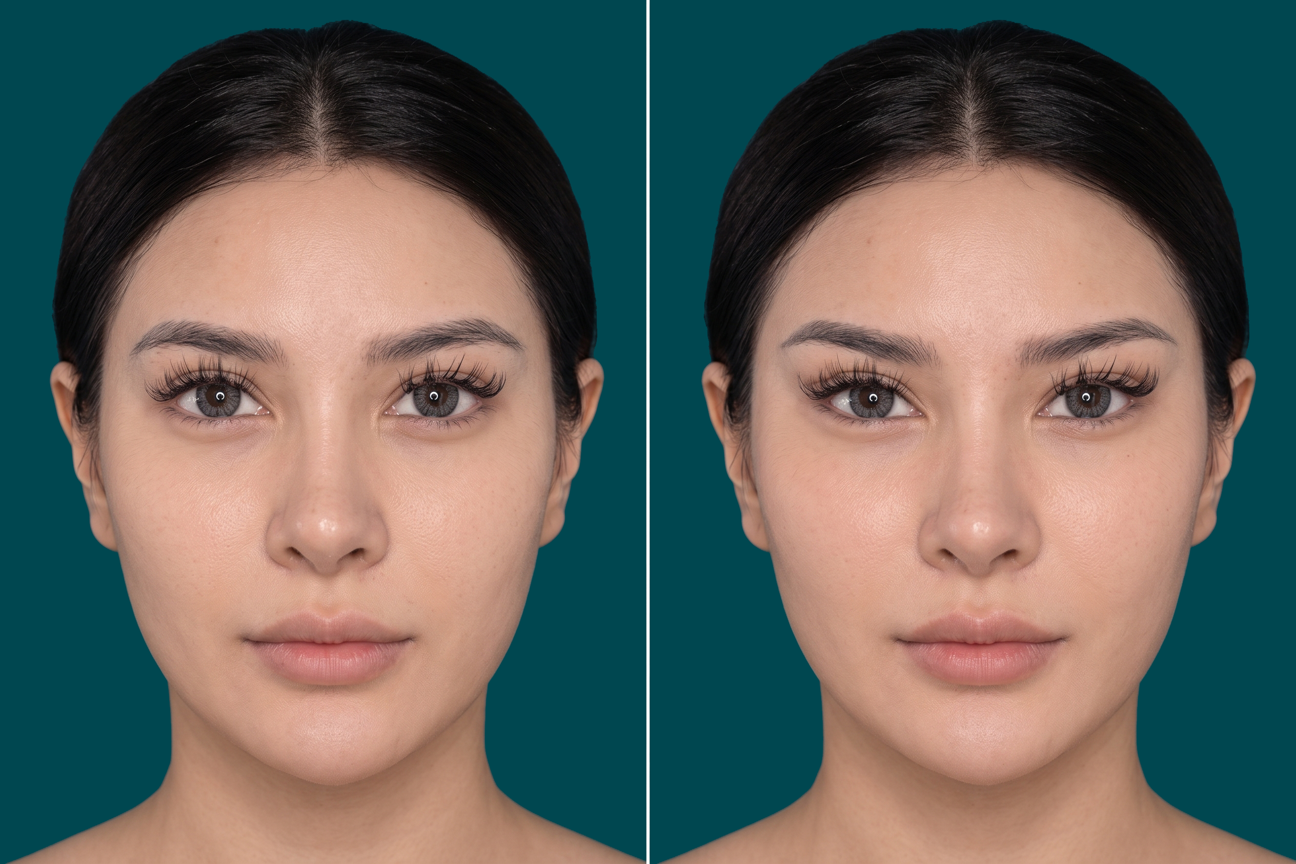 Fox Eye Lift Before and After 2