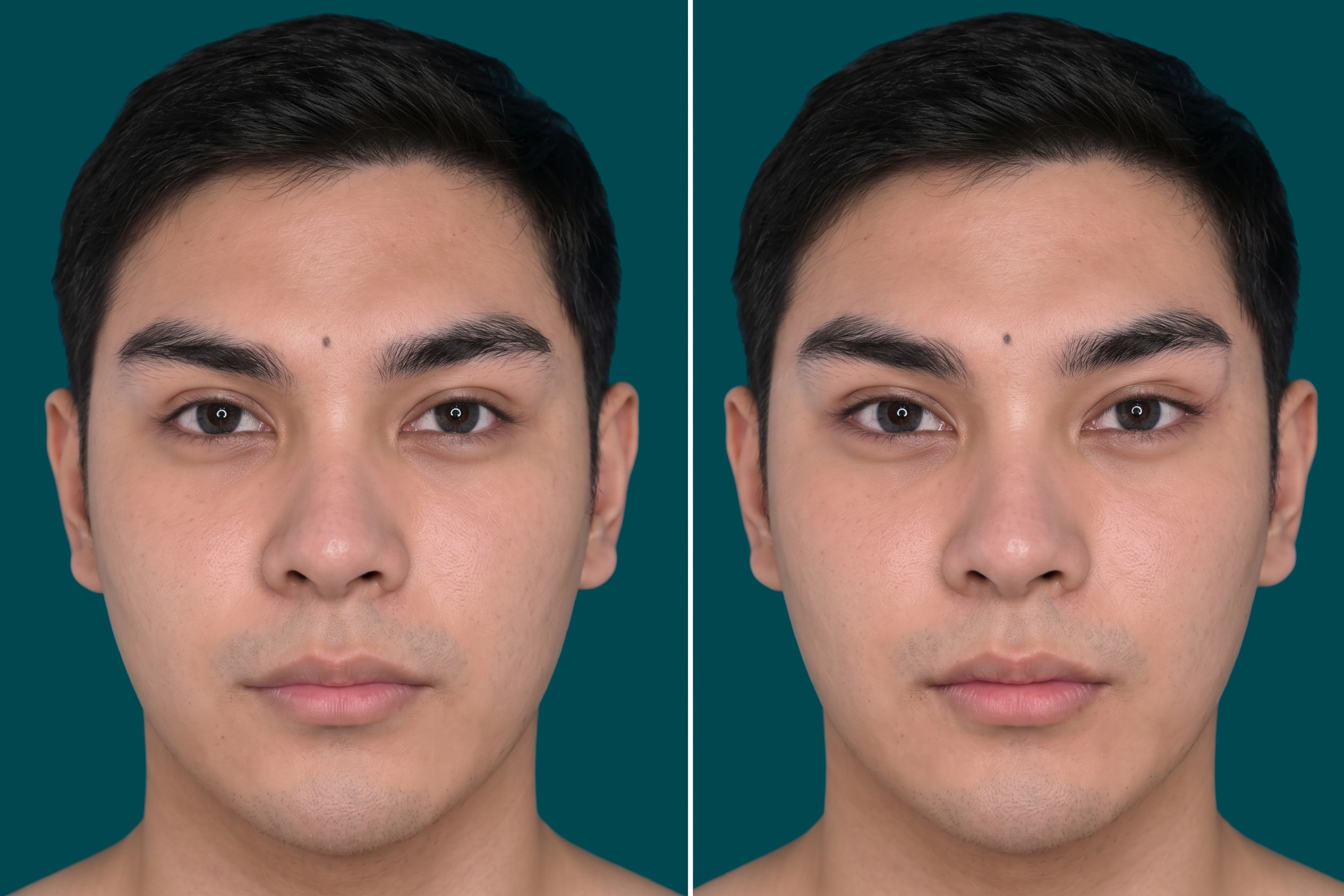 Fox Eye Lift Before and After 5