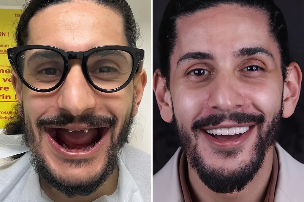 Full-Mouth-Dental-Implants