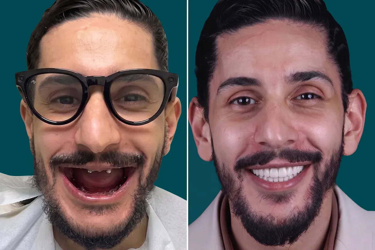 Full-Mouth-Dental-Implants