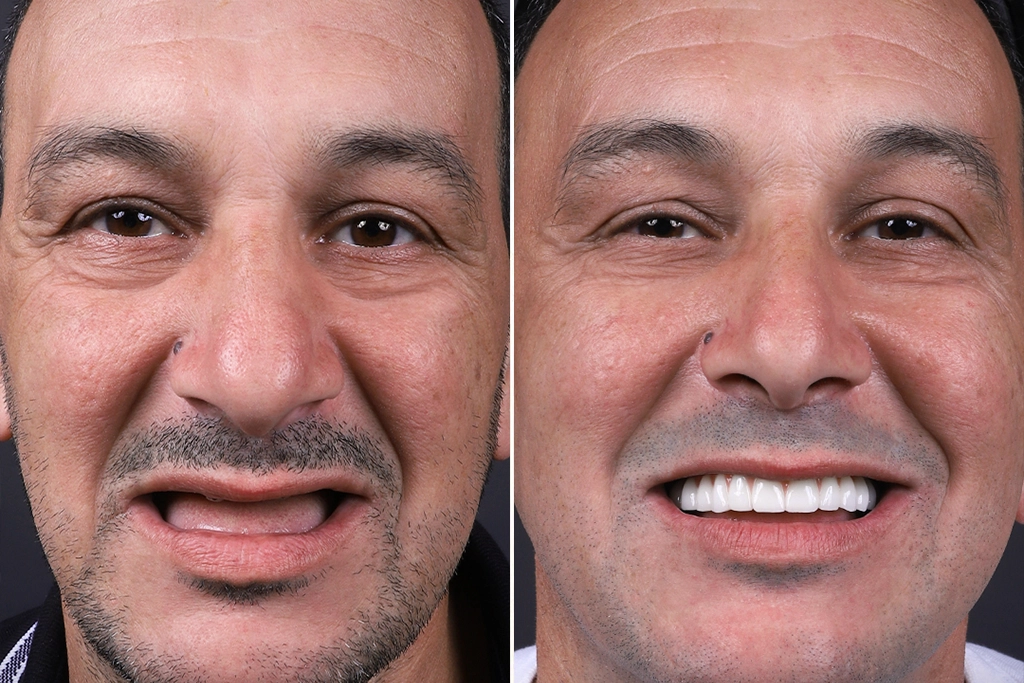 Before treatment