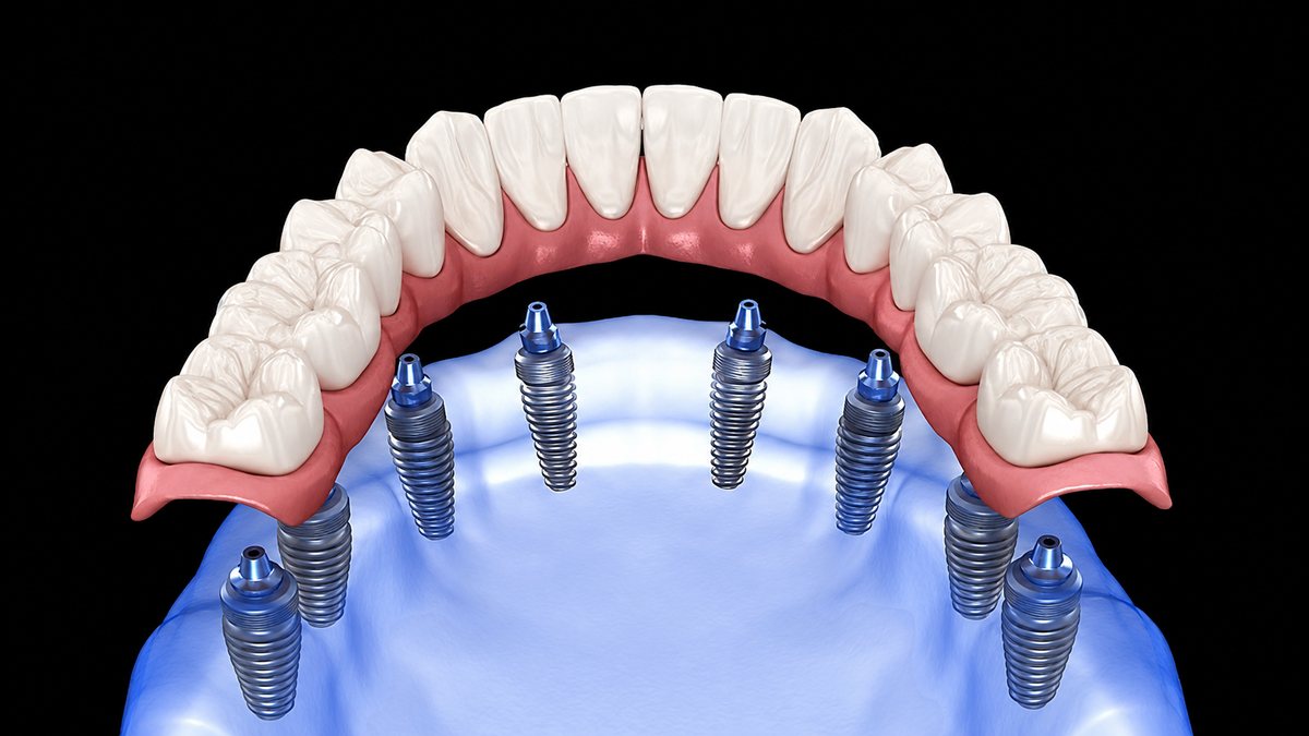 Full-Mouth-Dental-Implants