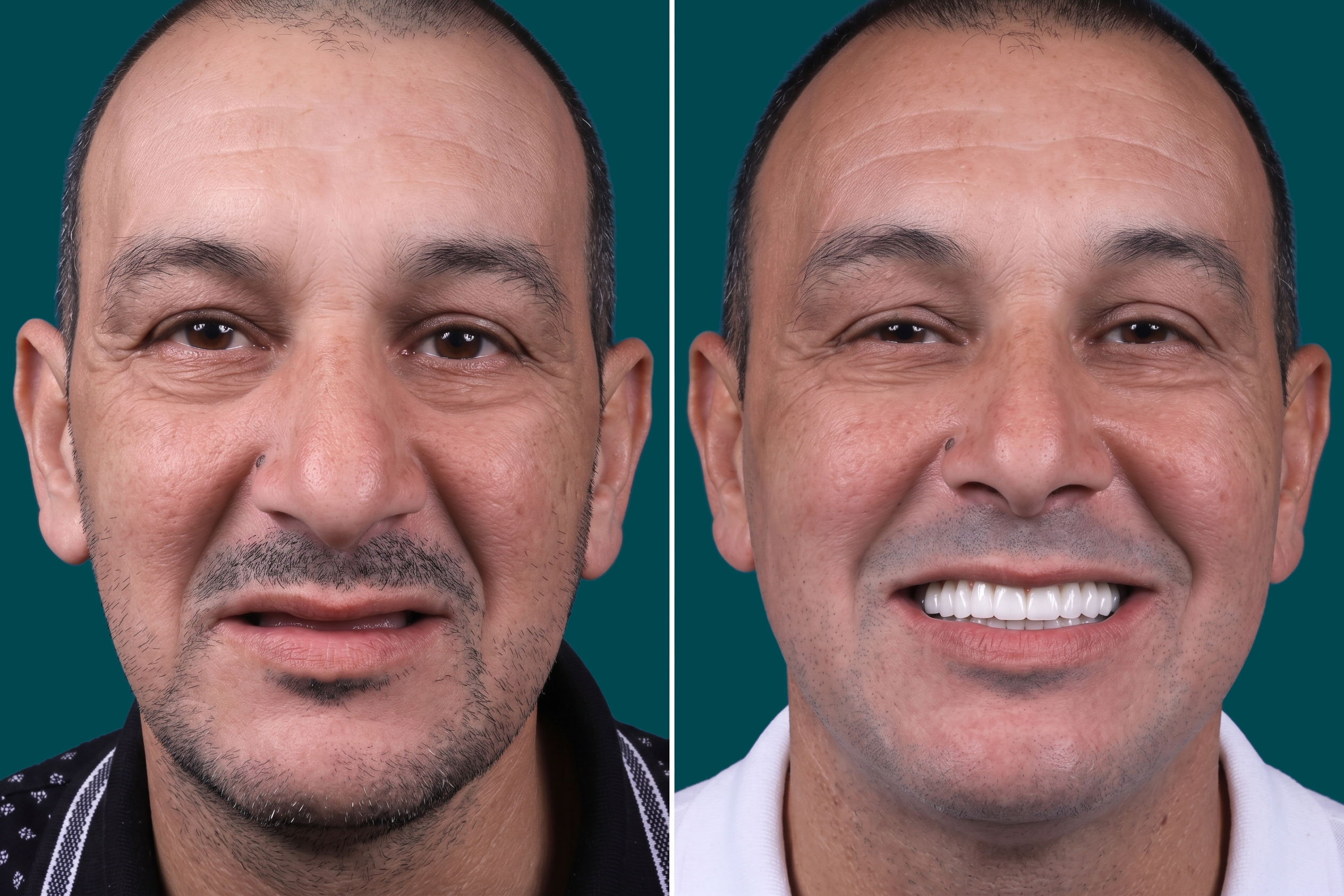 Dental Implants-Full Mouth Dental Implant 2