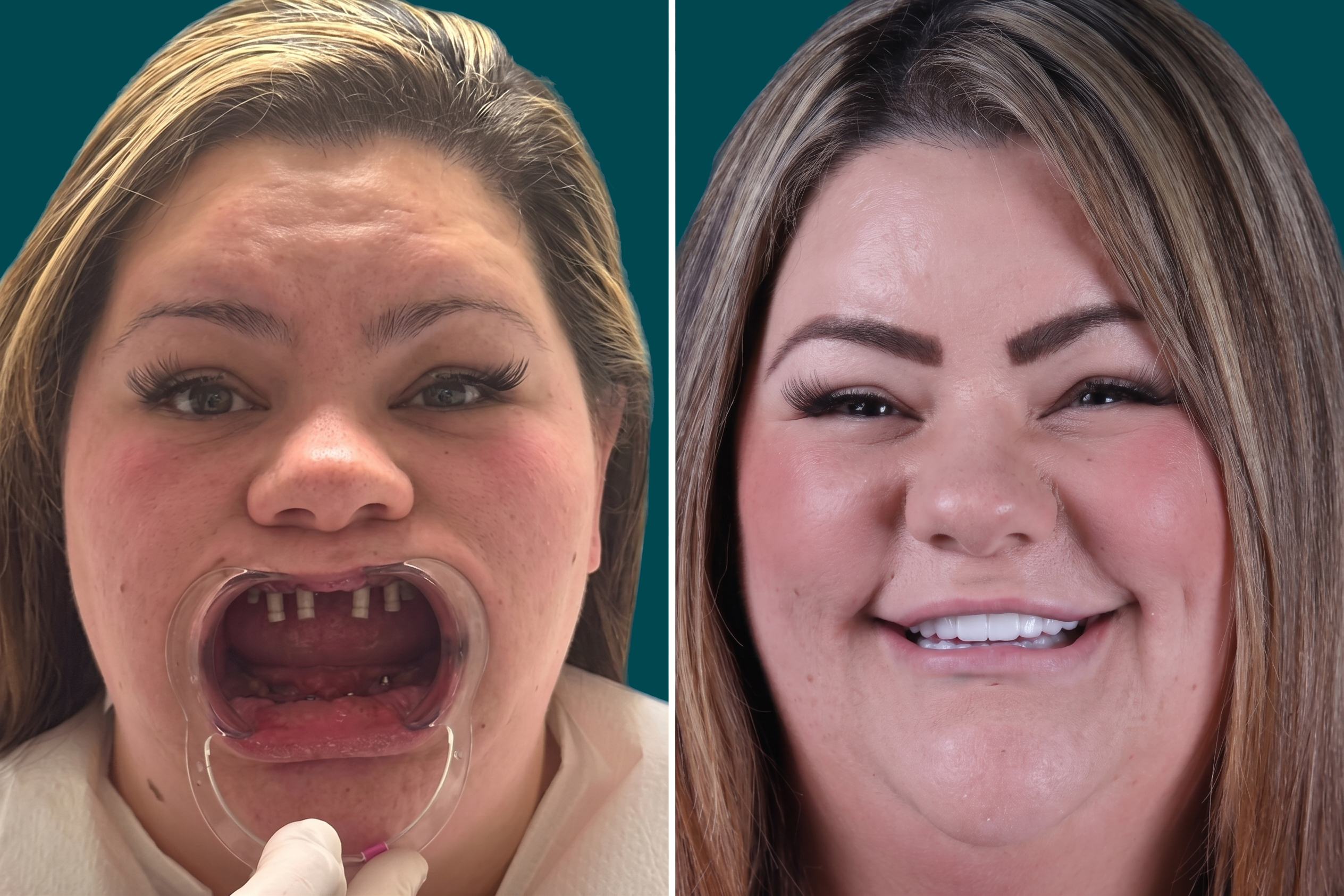 Smile-Makeover-Full-Mouth-Restoration 2