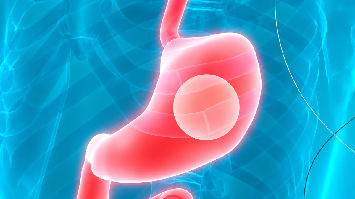 Gastric Balloon in Turkey