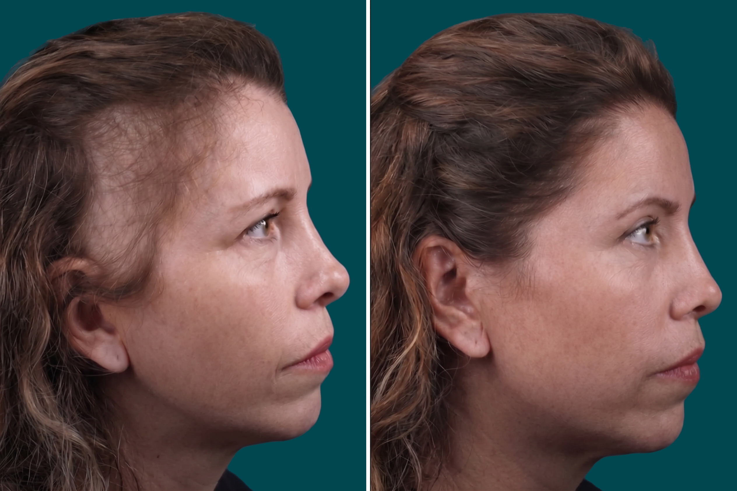 Female Hair Transplant