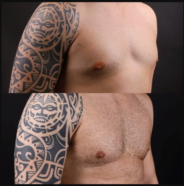 Gynecomastia-before-after.png