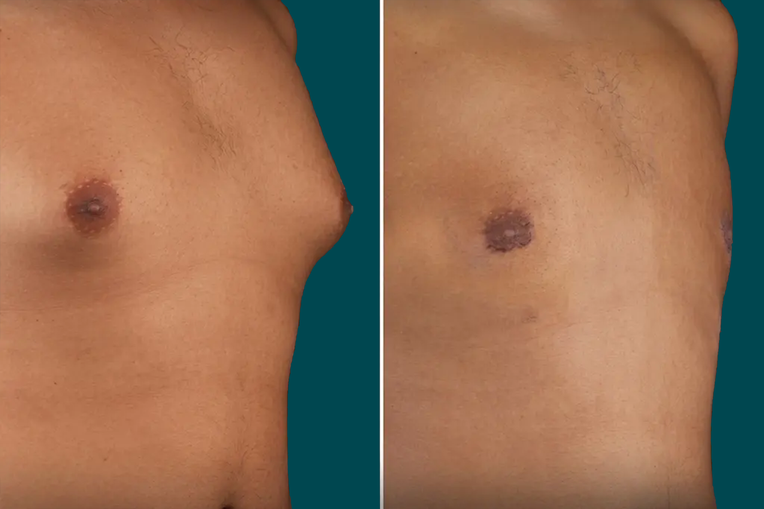 Gynecomastia Surgery Before and After 1