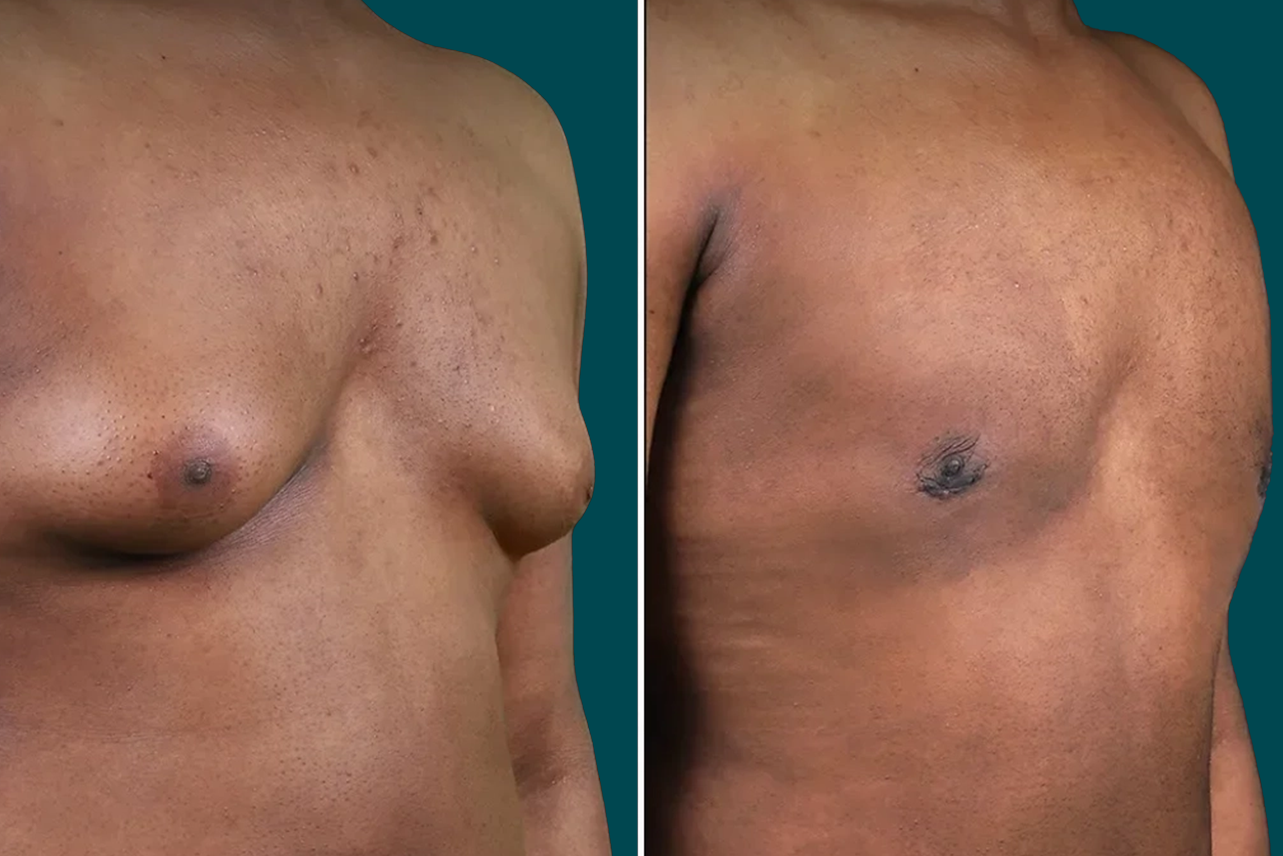 Gynecomastia Surgery Before and After 2