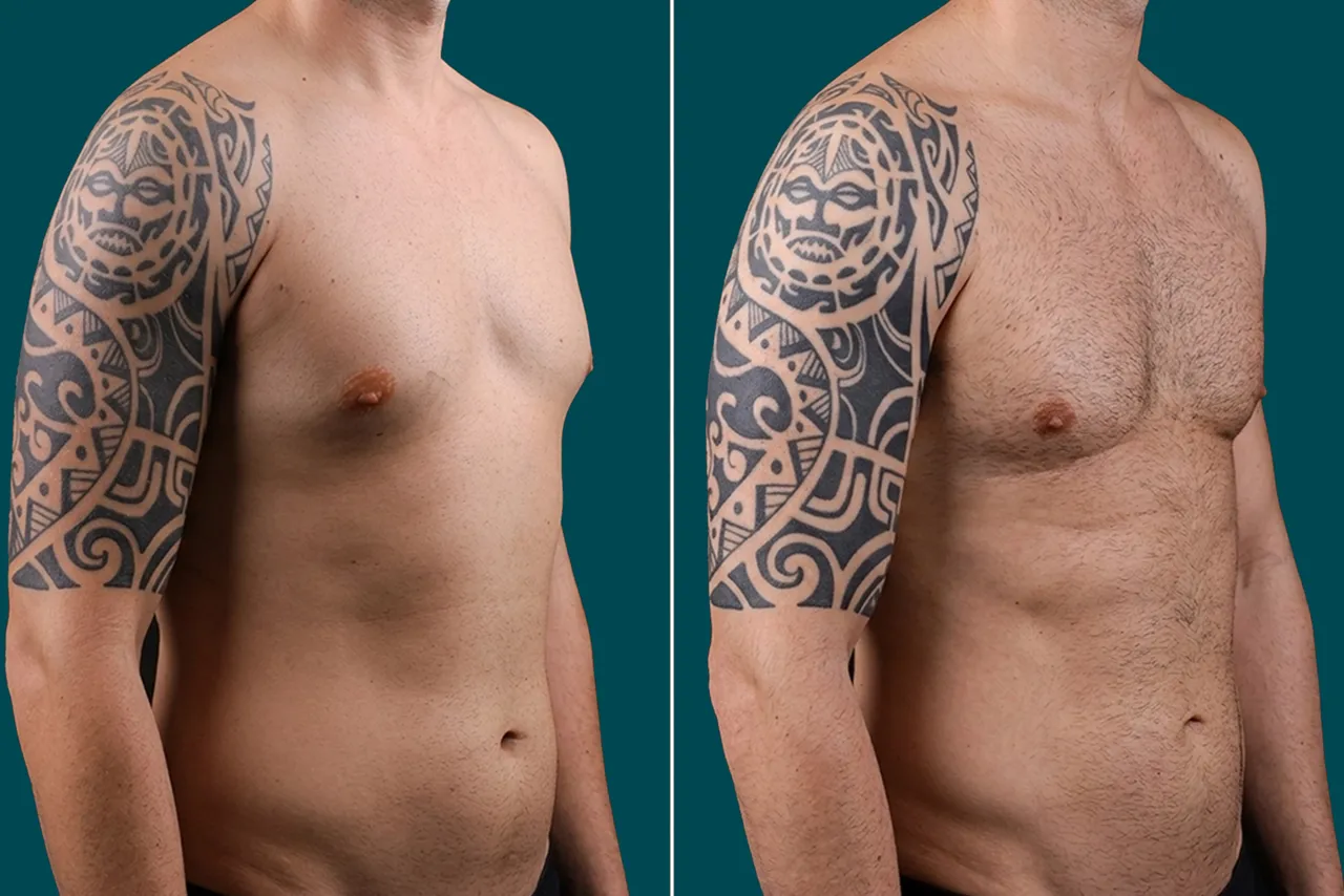 Gynecomastia Surgery Before and After 3